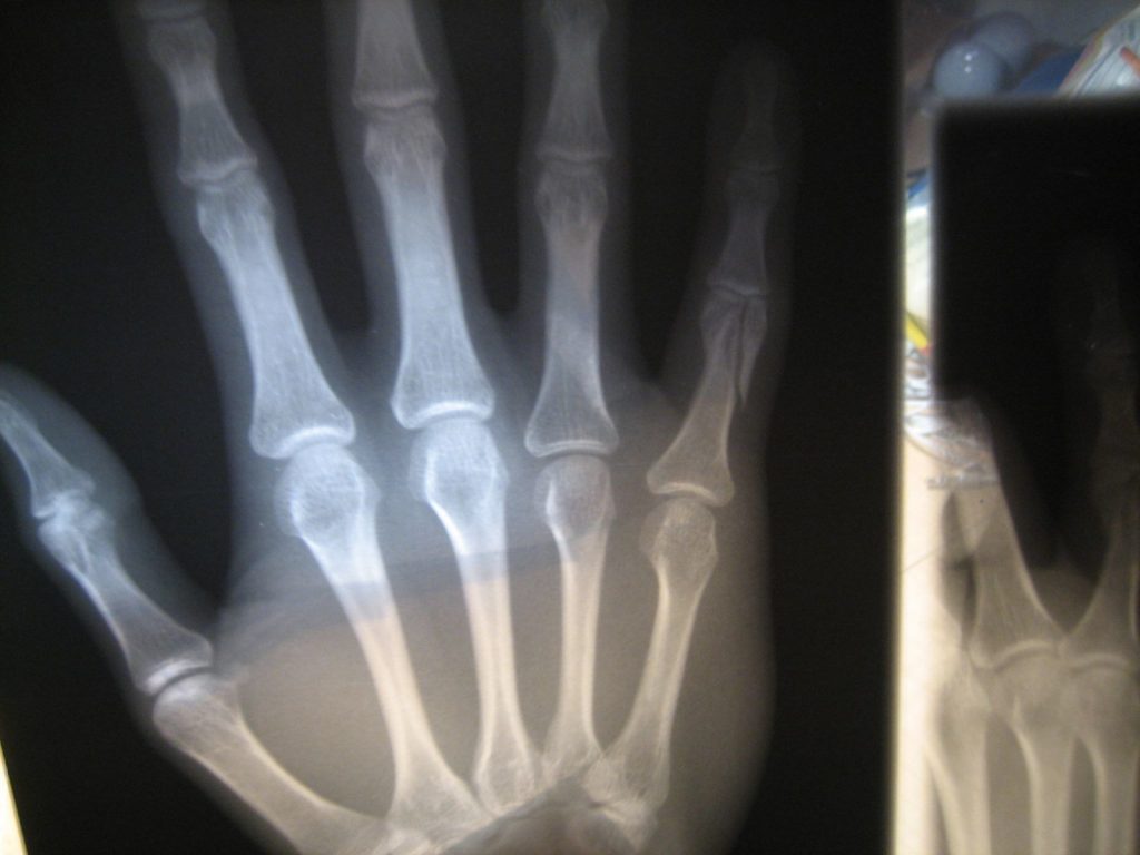 Odszkodowanie za złamany palec